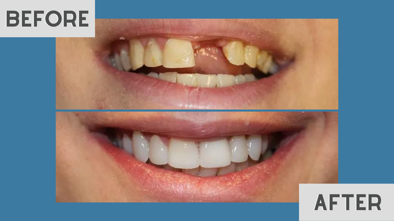 Before and after: a smile with a missing front tooth, restored with a complete, natural-looking replacement