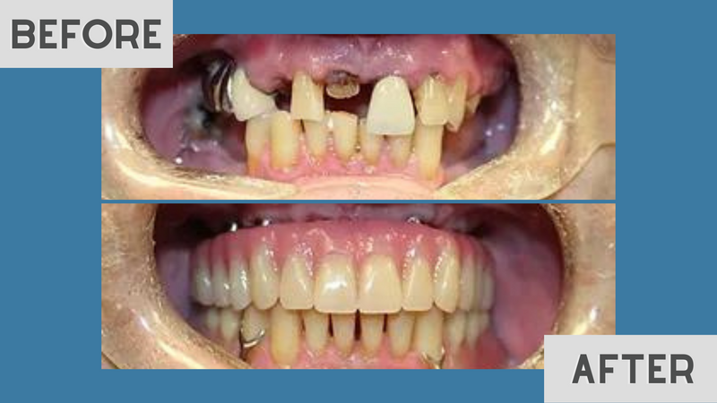 Before and after: severely damaged teeth restored with a complete arch of replacement teeth